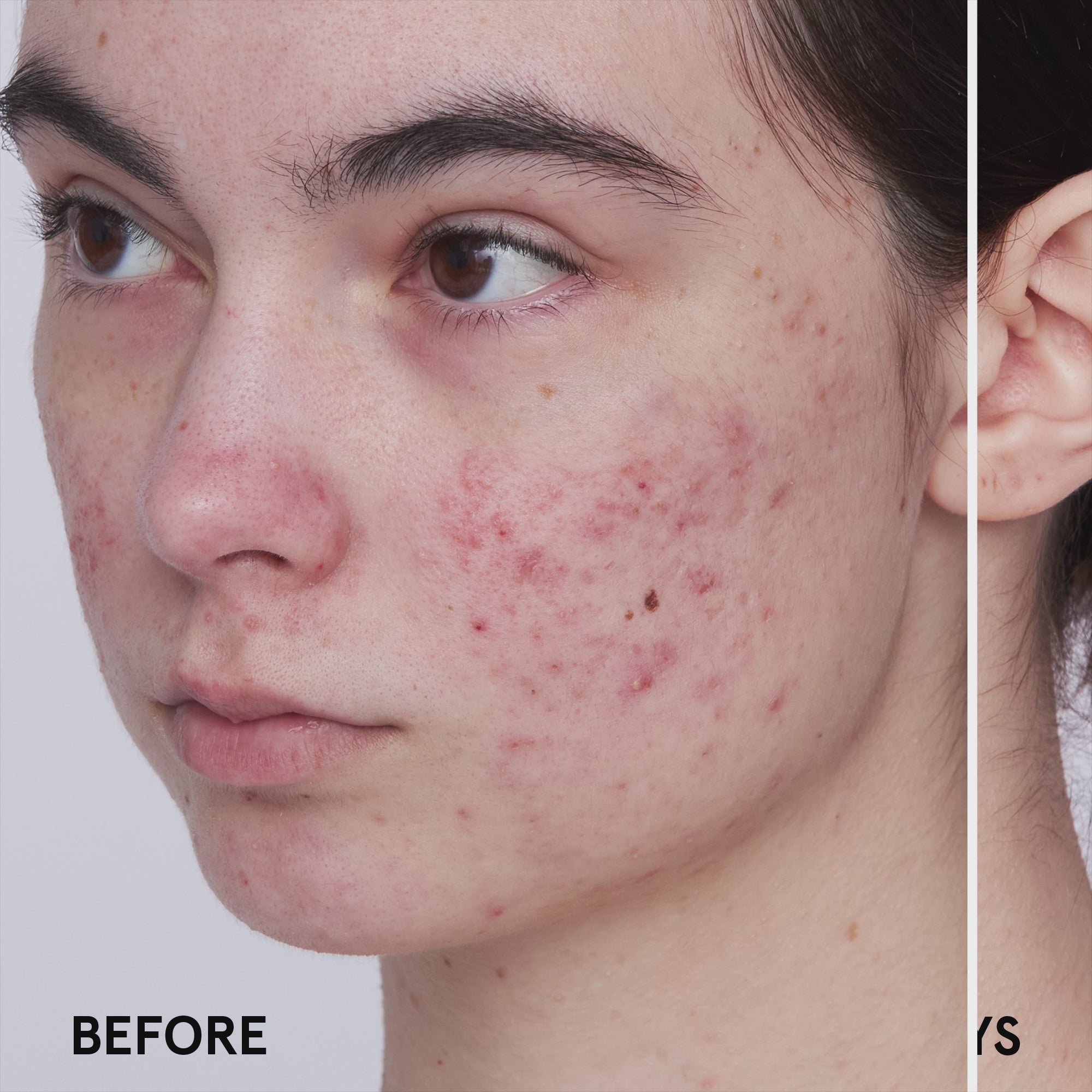 BLUE WAVE 2% Salicylic Acid Medicated Acne Clearing Serum | Herbivorebotanicalss